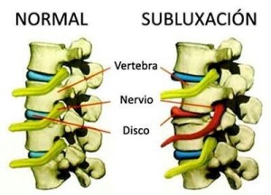 subluxation