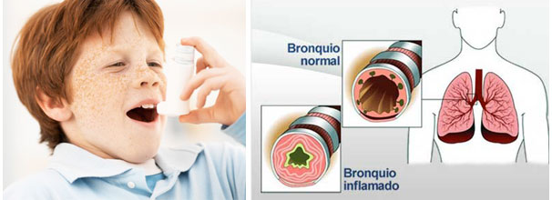 asma-quiropráctico-madrid[1]